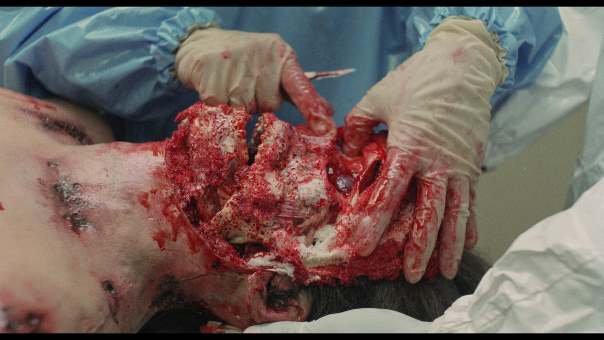 Ebola Syndrome